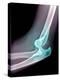 Dislocated Elbow, X-ray-Du Cane Medical-Premier Image Canvas