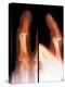 Dislocated Finger Joint, X-ray-ZEPHYR-Premier Image Canvas