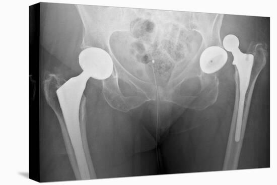 Dislocated Hip Replacement, X-ray-Du Cane Medical-Premier Image Canvas