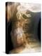 Dislocated Neck Bones, X-ray-ZEPHYR-Premier Image Canvas