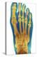 Dislocated Toe, X-ray-Du Cane Medical-Premier Image Canvas