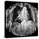 Dissecting Aorta, MRI Scan-Du Cane Medical-Premier Image Canvas