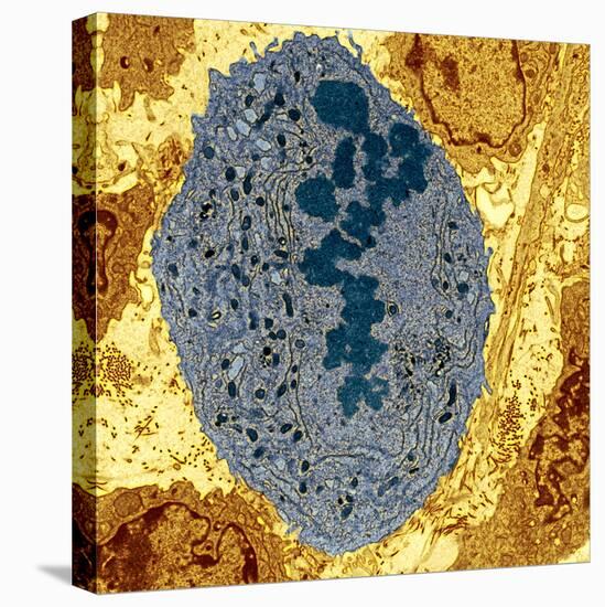 Dividing Sarcoma Cancer Cell, TEM-Steve Gschmeissner-Premier Image Canvas