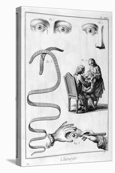 Eye Surgery, 1751-1777-Denis Diderot-Premier Image Canvas