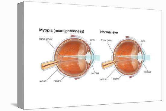 Farsighted Eye (Hyperopia). Convex Lens, Ophthalmology, Health and Disease-Encyclopaedia Britannica-Stretched Canvas