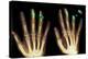 Fingertip Laceration Injuries, X-rays-Du Cane Medical-Premier Image Canvas