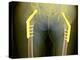 Fixed Double Hip Fracture (image 2 of 2)-Du Cane Medical-Premier Image Canvas