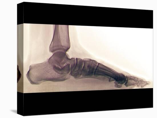 Flat Foot, X-ray-ZEPHYR-Premier Image Canvas