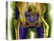 Fractured Femur-Du Cane Medical-Premier Image Canvas