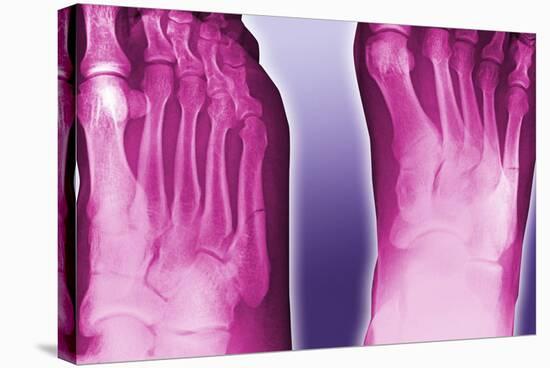 Fractured Foot, Coloured X-ray-Miriam Maslo-Premier Image Canvas