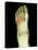 Fractured Foot, X-ray-Du Cane Medical-Premier Image Canvas