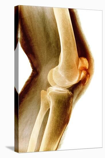 Fractured Kneecap, X-ray-Du Cane Medical-Premier Image Canvas