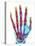 Fractured Palm Bones of Hand, X-ray-Science Photo Library-Premier Image Canvas