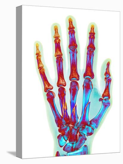 Fractured Palm Bones of Hand, X-ray-Science Photo Library-Premier Image Canvas