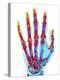 Fractured Palm Bones of Hand, X-ray-Science Photo Library-Premier Image Canvas