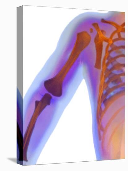 Fractured Shoulder, X-ray-Du Cane Medical-Premier Image Canvas