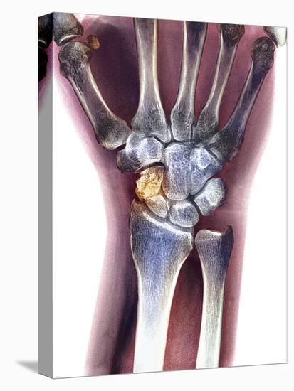 Fractured Wrist, X-ray-Du Cane Medical-Premier Image Canvas
