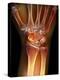 Fractured Wrist, X-ray-Du Cane Medical-Premier Image Canvas
