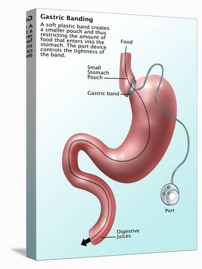 Gastric Banding-Gwen Shockey-Premier Image Canvas