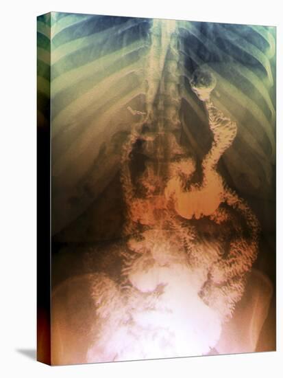 Gastric Bypass Surgery, X-ray-ZEPHYR-Premier Image Canvas