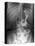 Gastric Bypass Surgery, X-ray-ZEPHYR-Premier Image Canvas