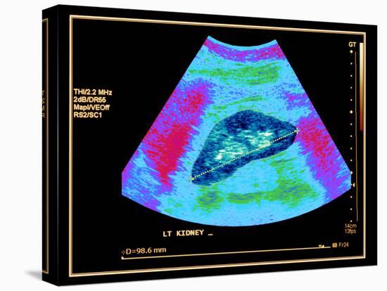 Healthy Kidney Measured, Ultrasound Scan-Science Photo Library-Premier Image Canvas