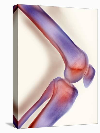 Healthy Knee, X-ray-Science Photo Library-Premier Image Canvas