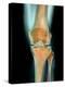 Healthy Knee, X-ray-Science Photo Library-Premier Image Canvas