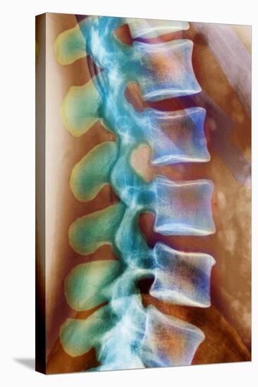 Healthy Lower Spine, X-ray-Science Photo Library-Premier Image Canvas