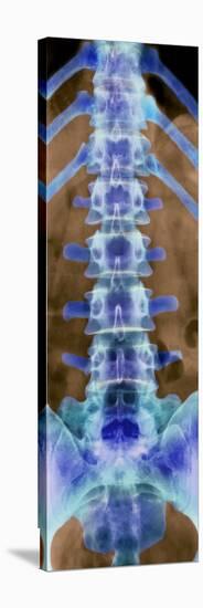 Healthy Lower Spine, X-ray-Science Photo Library-Premier Image Canvas