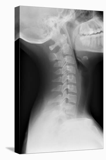 Healthy Spine of the Neck, X-ray'-Du Cane Medical-Premier Image Canvas