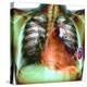 Heart Pacemaker, X-ray-Du Cane Medical-Premier Image Canvas