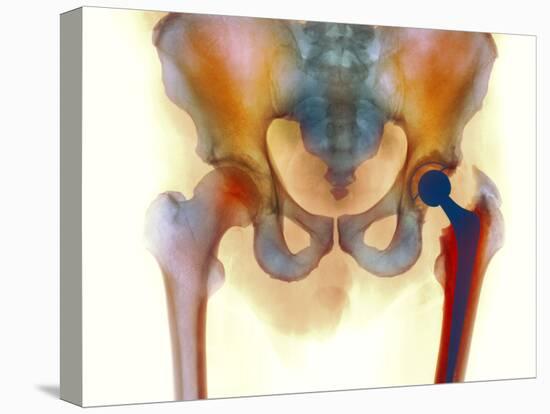 Hip Joint Replacement, X-ray-Science Photo Library-Premier Image Canvas