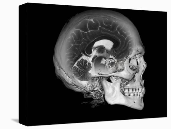 Human Skull and Brain, CT and MRI Scans-null-Premier Image Canvas