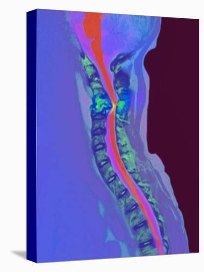 Inflamed Spinal Discs, MRI Scan-Du Cane Medical-Premier Image Canvas