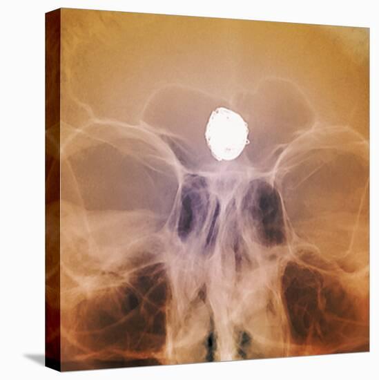 Intracranial Berry Aneurysm, X-ray-ZEPHYR-Premier Image Canvas