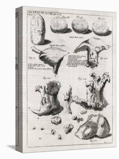 Kidney Stones, 18th Century-Middle Temple Library-Premier Image Canvas