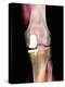 Knee Joint Prosthesis, X-ray-Science Photo Library-Premier Image Canvas