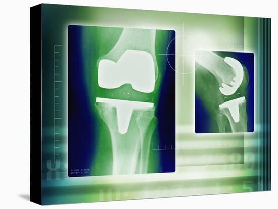 Knee Replacement, X-rays-Miriam Maslo-Premier Image Canvas