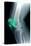 Kneecap Fracture, X-ray-Du Cane Medical-Premier Image Canvas