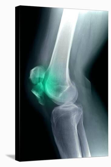 Kneecap Fracture, X-ray-Du Cane Medical-Premier Image Canvas