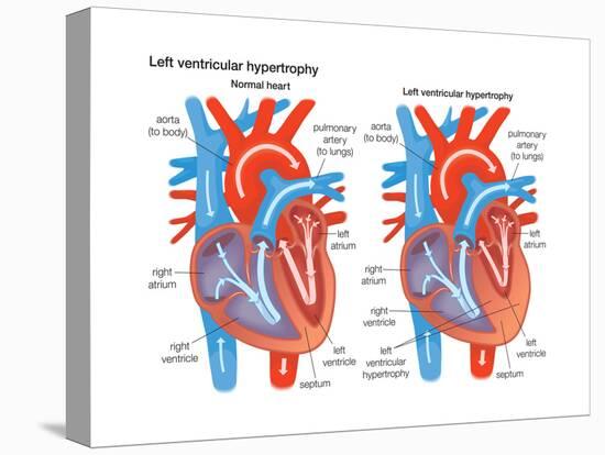 Left Ventricular Hypertrophy-Encyclopaedia Britannica-Stretched Canvas