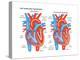 Left Ventricular Hypertrophy-Encyclopaedia Britannica-Stretched Canvas