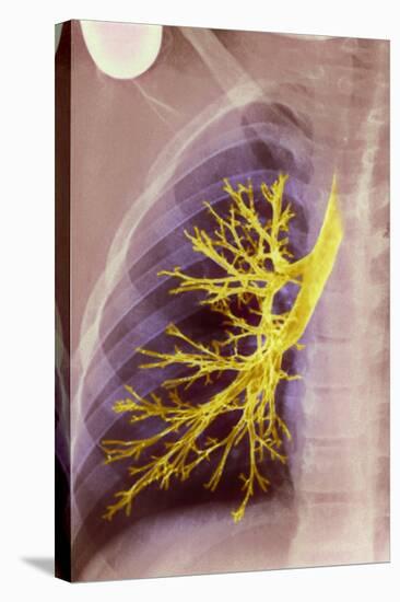 Lung Bronchioles, X-ray-null-Premier Image Canvas