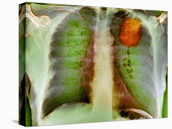 Lung Cancer, X-ray-Du Cane Medical-Premier Image Canvas