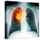 Lung Cancer, X-ray-Du Cane Medical-Premier Image Canvas