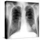 Lung Cancer, X-ray-Du Cane Medical-Premier Image Canvas