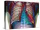 Lung Infection-Du Cane Medical-Premier Image Canvas