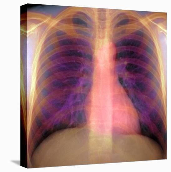 Lungs And Heart, X-ray-Du Cane Medical-Premier Image Canvas