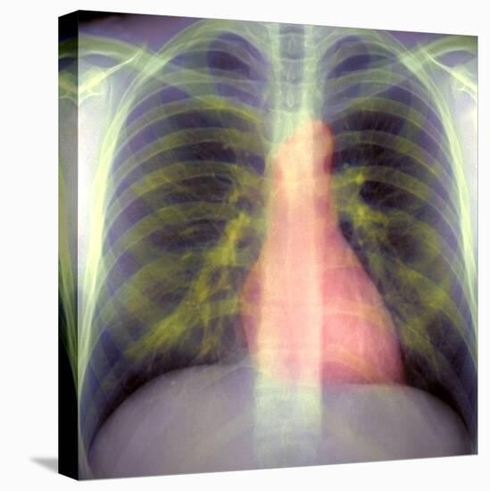 Lungs And Heart, X-ray-Du Cane Medical-Premier Image Canvas